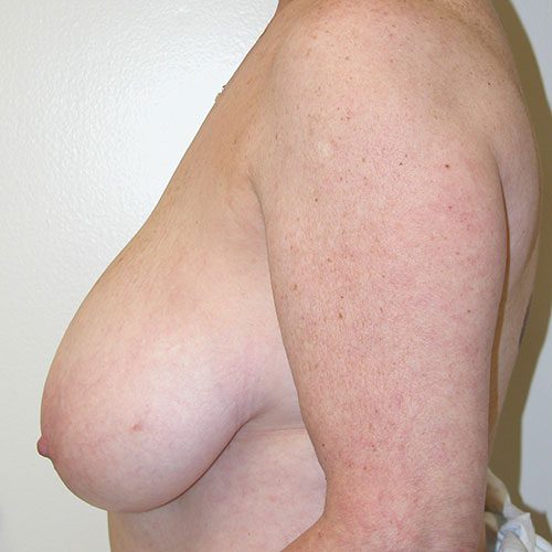 Breast Reduction 44 Before Photo