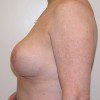 Breast Reduction 44 After Photo Thumbnail