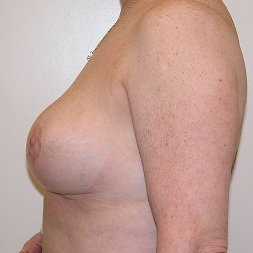 Breast Reduction 44 After Photo