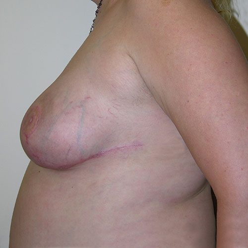 Breast Reduction 45 After Photo