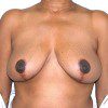 Breast Reduction 46 After Photo Thumbnail
