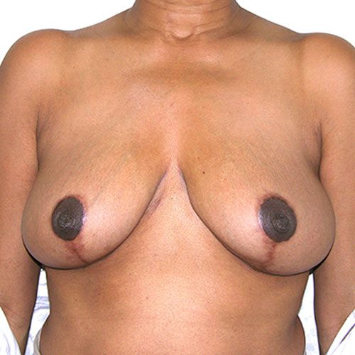 Breast Reduction 46 After Photo 