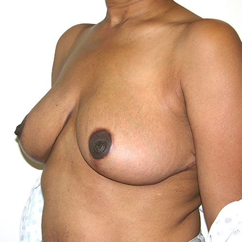 Breast Reduction 46 After Photo