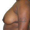 Breast Reduction 47 Before Photo Thumbnail