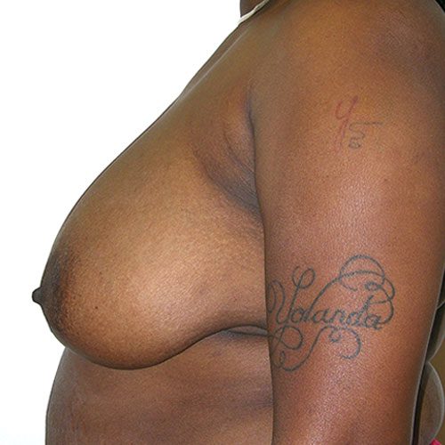 Breast Reduction 47 Before Photo