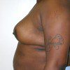 Breast Reduction 47 After Photo Thumbnail