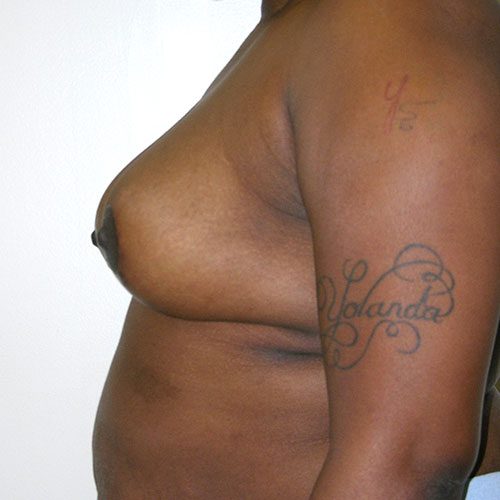 Breast Reduction 47 After Photo