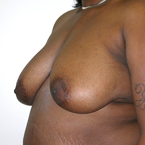 Breast Reduction 47 Before Photo