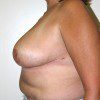 Breast Reduction 48 After Photo Thumbnail