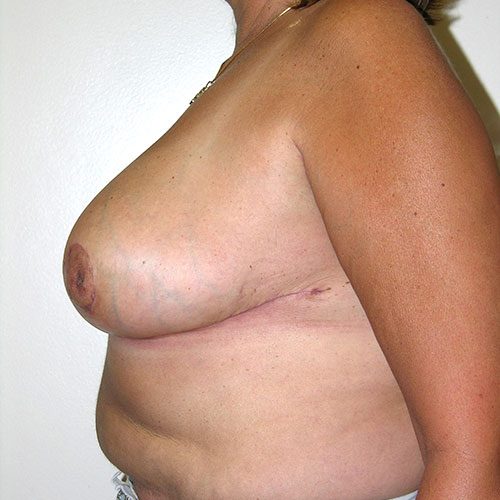 Breast Reduction 48 After Photo