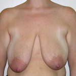 Breast Reduction 49 Before Photo - 2