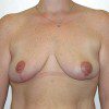 Breast Reduction 49 After Photo Thumbnail