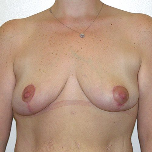 Breast Reduction 49 After Photo 