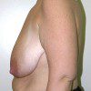Breast Reduction 49 Before Photo Thumbnail