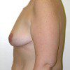 Breast Reduction 49 After Photo Thumbnail