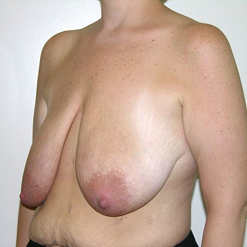 Breast Reduction 49 Before Photo