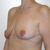 Breast Reduction 49 After Photo Thumbnail