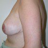 Breast Reduction 50 After Photo Thumbnail