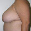 Breast Reduction 51 Before Photo Thumbnail