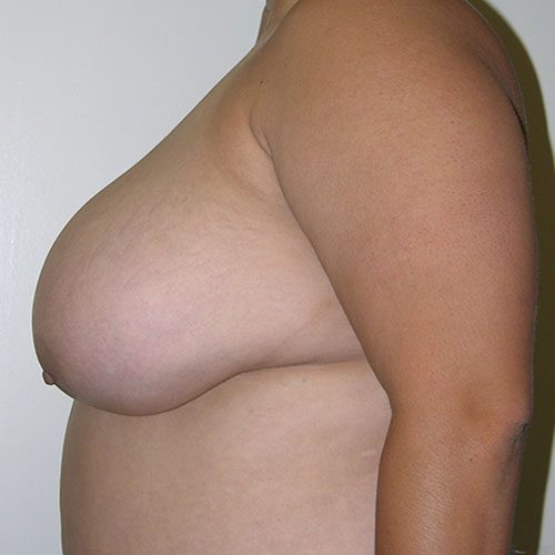 Breast Reduction 51 Before Photo