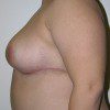 Breast Reduction 51 After Photo Thumbnail