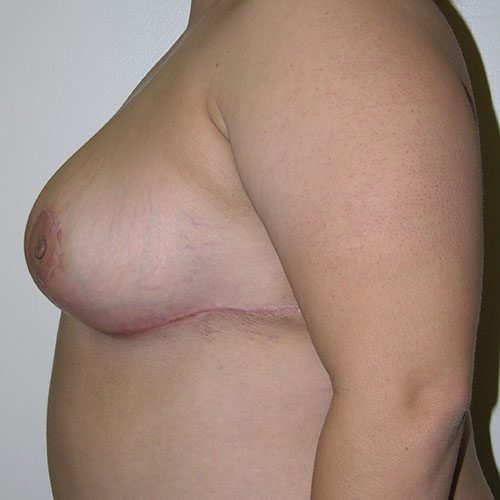 Breast Reduction 51 After Photo