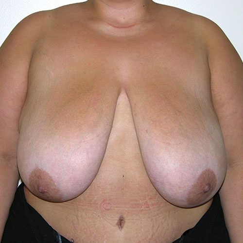 Breast Reduction 52 Before Photo 