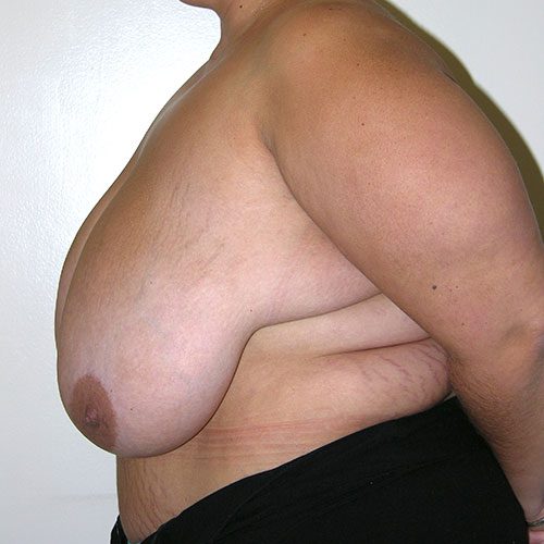 Breast Reduction 52 Before Photo