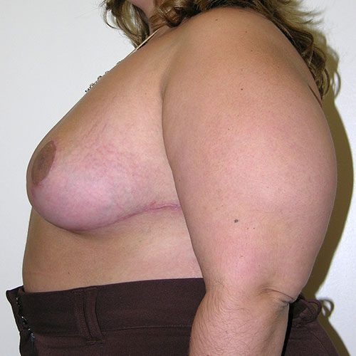 Breast Reduction 52 After Photo