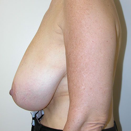 Breast Reduction 53 Before Photo