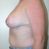 Breast Reduction 54 After Photo Thumbnail