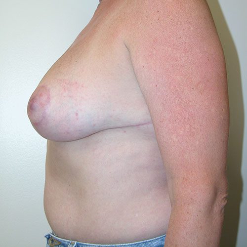 Breast Reduction 54 After Photo