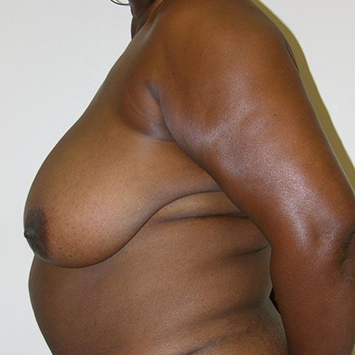 Breast Reduction 55 Before Photo