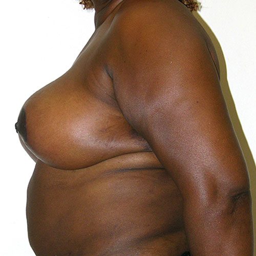 Breast Reduction 55 After Photo