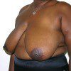 Breast Reduction 55 Before Photo Thumbnail