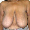 Breast Reduction 57 Before Photo Thumbnail