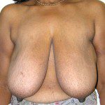 Breast Reduction 57 Before Photo - 6