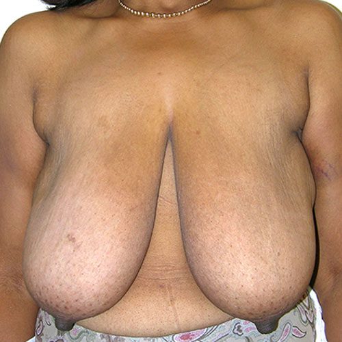Breast Reduction 57 Before Photo 