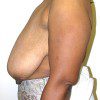 Breast Reduction 57 Before Photo Thumbnail
