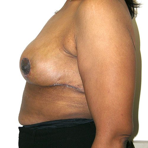 Breast Reduction 57 After Photo