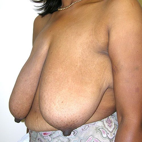 Breast Reduction 57 Before Photo