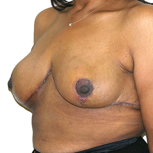 Breast Reduction 57 After Photo