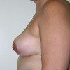 Breast Reduction 58 After Photo Thumbnail
