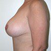 Breast Reduction 59 Before Photo Thumbnail