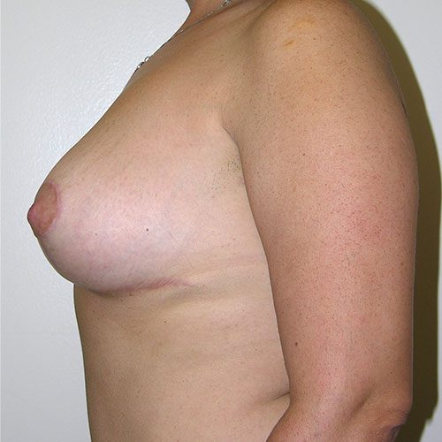 Breast Reduction 59 After Photo
