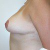 Breast Reduction 60 After Photo Thumbnail