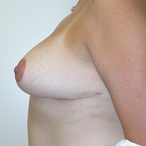 Breast Reduction 60 After Photo