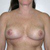 Breast Reduction 62 After Photo Thumbnail