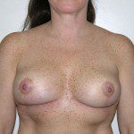 Breast Reduction 62 After Photo - 1