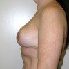 Breast Reduction 62 After Photo Thumbnail